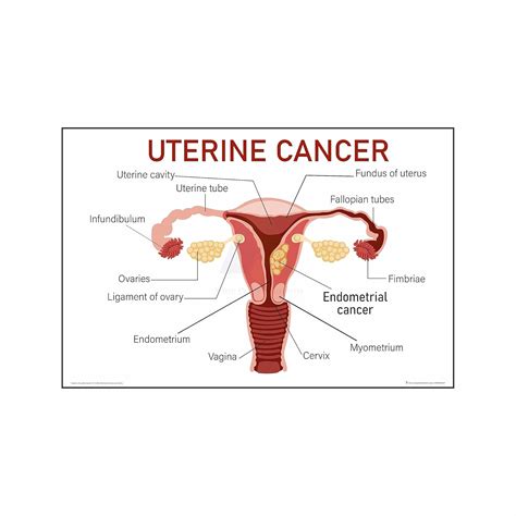 Anne Print Solutions® Uterine Cancer chart Poster For Hospital Posters ...