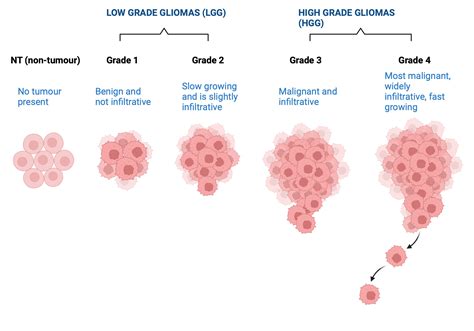 High Grade Glioma