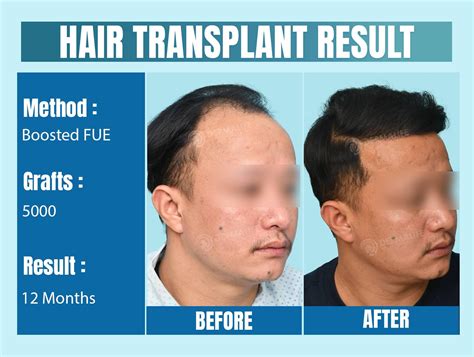 Hair Transplant Before After Result of Crown Area