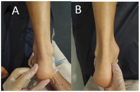 A New Test for Achilles Tendinopathy Based on Kager’s Fat Pad Clinical ...