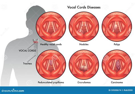 Reinke's Edema Of Vocal Cords at Abigail Chambers blog