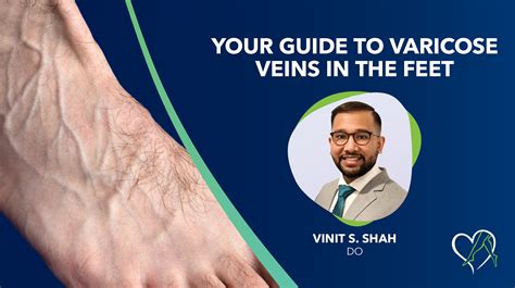 Learn About Varicose Veins & Treatments | Center for Vein Restoration