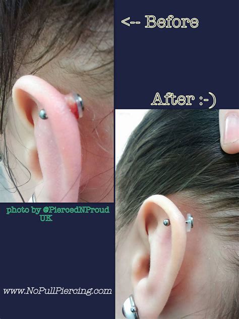 Keloid Scars From Industrial Piercing | Best Piercing Ideas