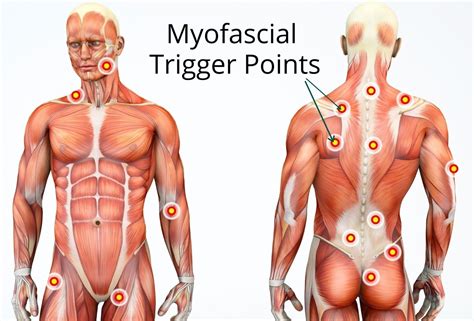 Muscle Knots & Myofascial Trigger Points