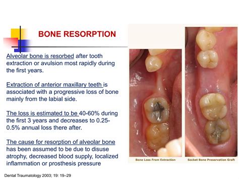 alveolar ridge expansion and socket preservation | PPT