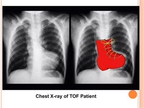Tetralogy of Fallot (TOF) | PPTX