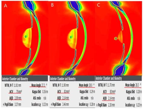 Long-Term Outcome of Corneal and Anterior Chamber Angle Parameters ...