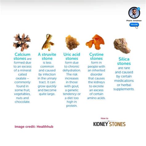 KIDNEY STONES 101 Kidney stones can be extremely painful But the good news is that they are ...