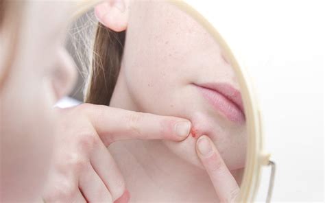 Image result for Exploding Face Zits