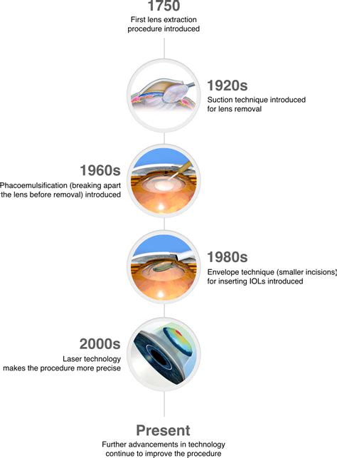 https://d3b3by4navws1f.cloudfront.net/cataract-surgery-timeline.png