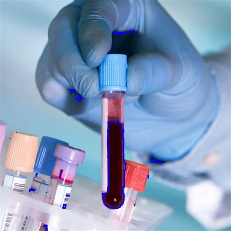 Image result for Normal Blood Segmenter Values