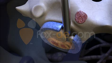 Medial Branch Block Injections | Fox Animated Engineering