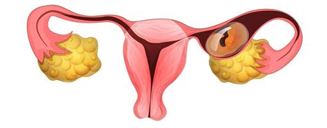 Ectopic Pregnancy