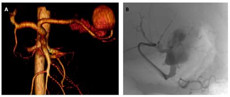 Splenic Artery Aneurysm