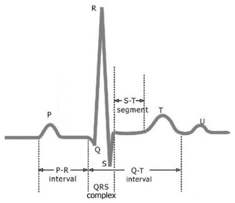 ECG Signal De-noising and Baseline Wander Correction Based on CEEMDAN ...