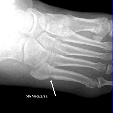 Metatarsal Bones Pain Foot And Ankle Pain Diagram By Area | Long