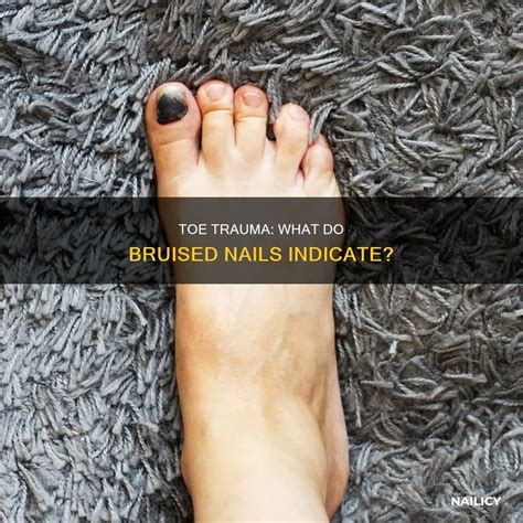 Toe Trauma: What Do Bruised Nails Indicate? | Nailicy