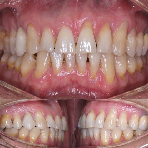 Smart Aligner 的图像结果