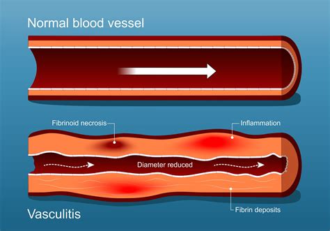 The Current Diagnostic and Treatment Landscape of Systemic Vasculitis