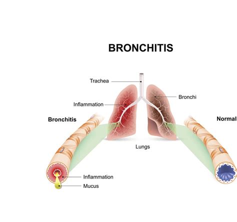 Acute bronchitis Guide: Causes, Symptoms and Treatment Options