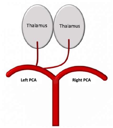 Stroke masquerading as cardiac arrest: the artery of Percheron | BMJ Case Reports