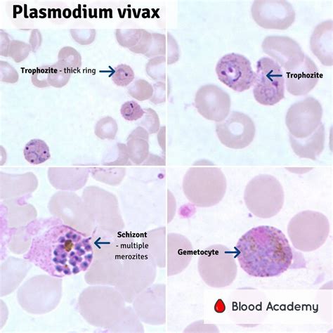 Plasmodium Blood Smear at Michael Nipper blog