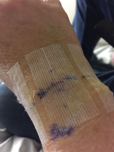 Ganglion Cyst Removal / Excision Recovery Pictures – Jenny Smith