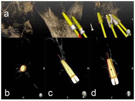 Accuracy Evaluation of 14 Maxillary Full Arch Implant Treatments ...