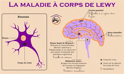 La maladie à corps de Lewy