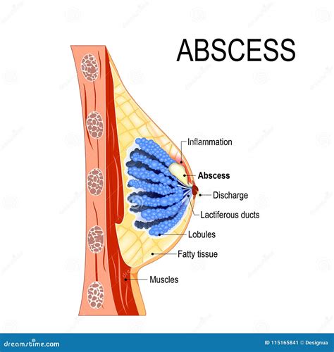 Abscess. Cross-section of the Mammary Gland with Inflammation Stock ...