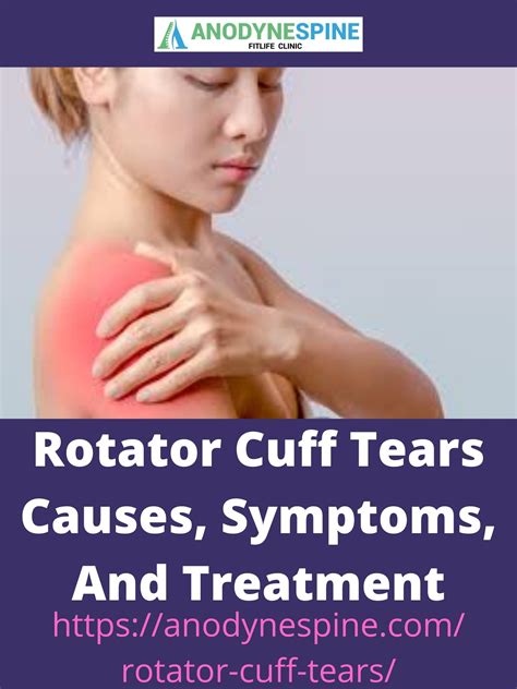 Rotator cuff injury healing – Artofit