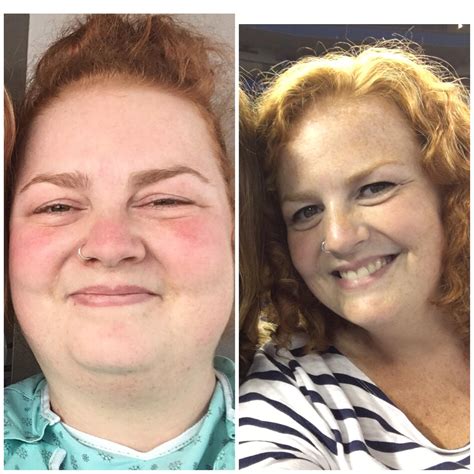 Cushing Syndrome Before And After