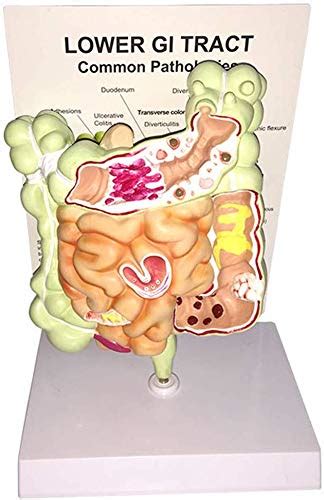 Buy LXX Human Digestive System Model - Gut Anatomy Intestinal Lesion ...