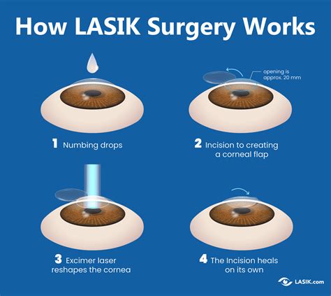 How Does LASIK Eye Surgery Work? | LASIK