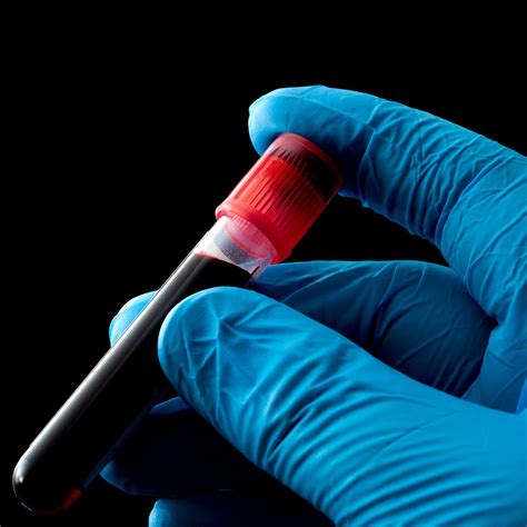 DNA Test Outperforms PET/CT Scans When Detecting Lymphoma