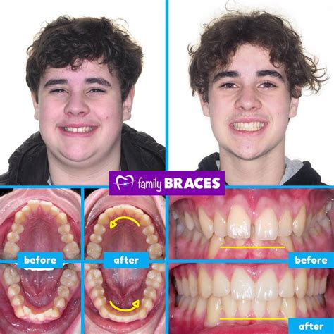 Braces Before And After Gap