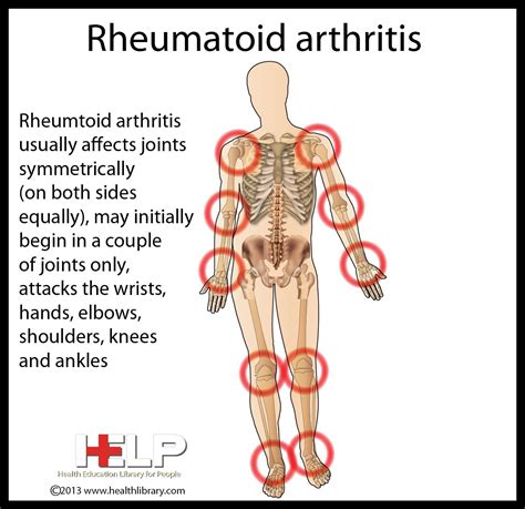 Rheumatoid arthritis symptoms causes and natural support strategies – Artofit
