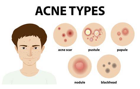 Acne Types