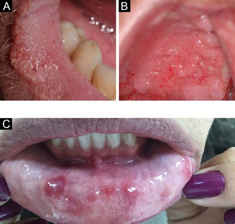 How To Remove Hpv Warts On Lips Reddit - Infoupdate.org