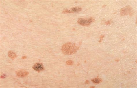 Dark Spots - Causes, Prevention Tips And Treatments – SkinKraft