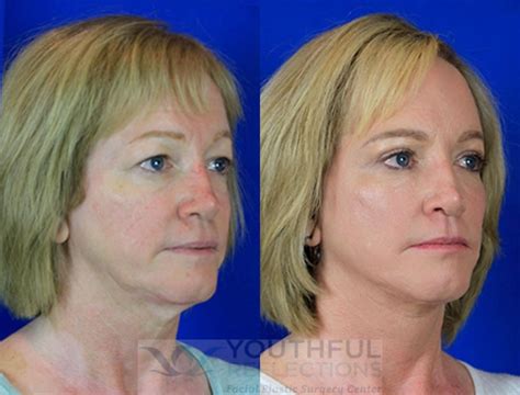 New Laser Facelift Procedure at Megan Cisneros blog