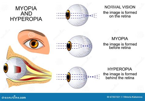 Image result for Myopia Hyperopia