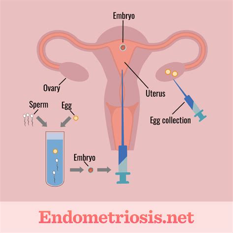 Assisted Reproductive Technology (ART) for Endometriosis