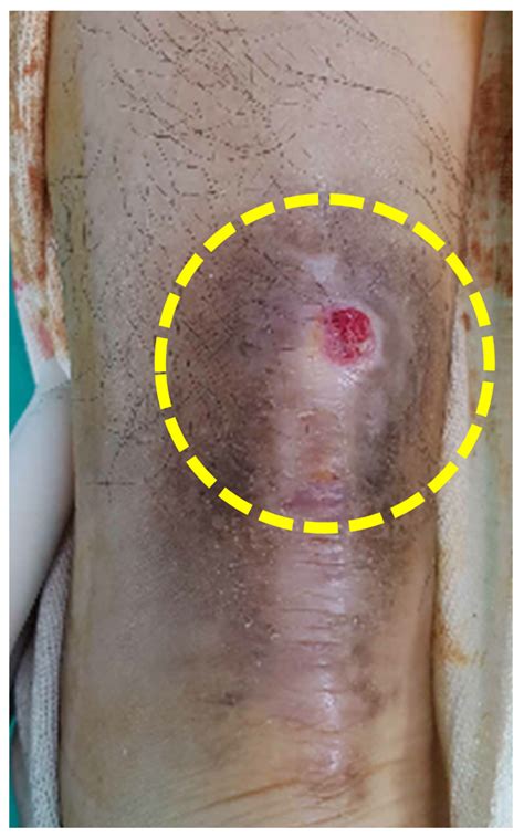 Clinical Features and Treatment of Intra-Tendinous Suture Reaction ...
