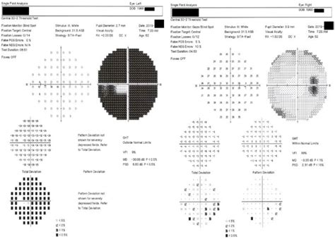 Image result for Visual Fielda Test