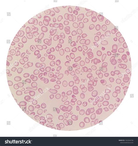Microscopic Images Abnormal Red Blood Cells Stock Photo (Edit Now ...