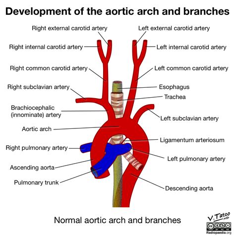 What Is A Normal Aortic Arch at Bev Wood blog