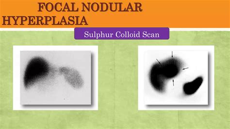 LIVER LUMPS- Rt Upper Quadrant Lumps- Abdominal Lumps.pptx