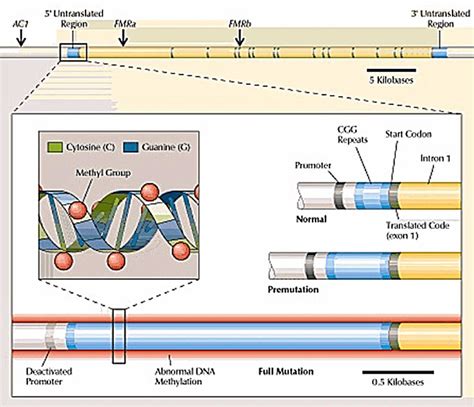 Fragile X syndrome causes, inheritance, symptoms, diagnosis & treatment