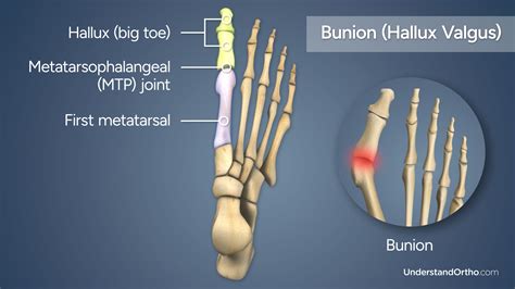 Bunionectomy – UnderstandOrtho™
